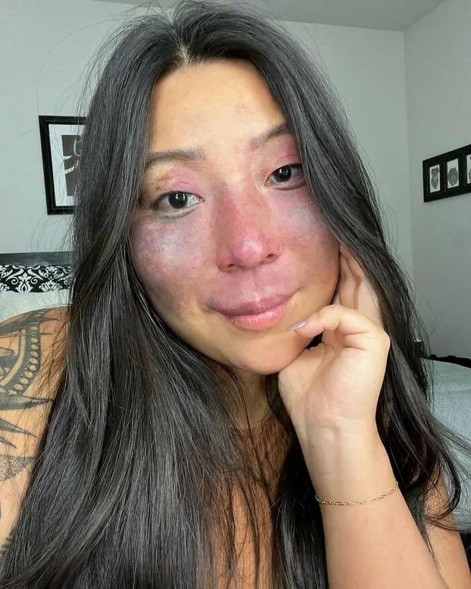 胎记长什么样子