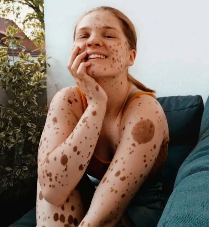 胎记长什么样子