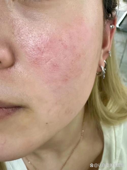 假的护肤品对皮肤过敏