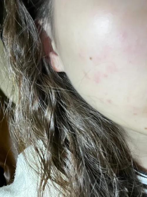 假的护肤品对皮肤过敏