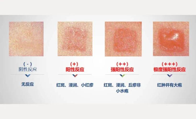 过敏源都有什么