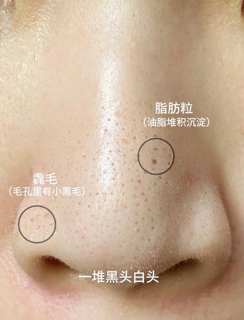 黑头是什么颜色的
