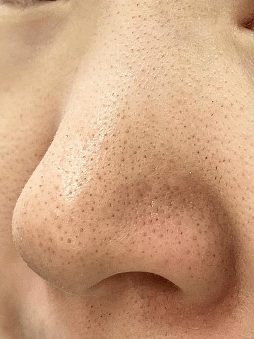 黑头是什么颜色的