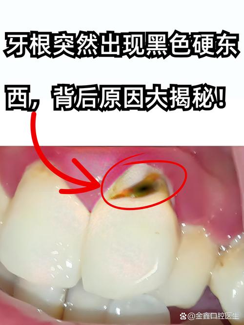 牙龈黑是什么原因
