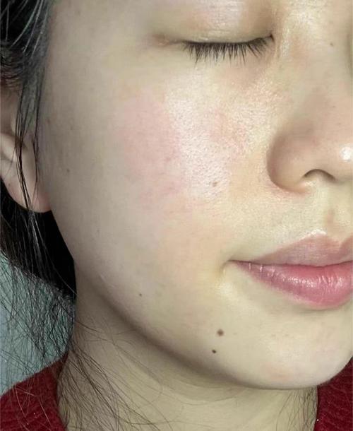 用美白的护肤品长痘痘