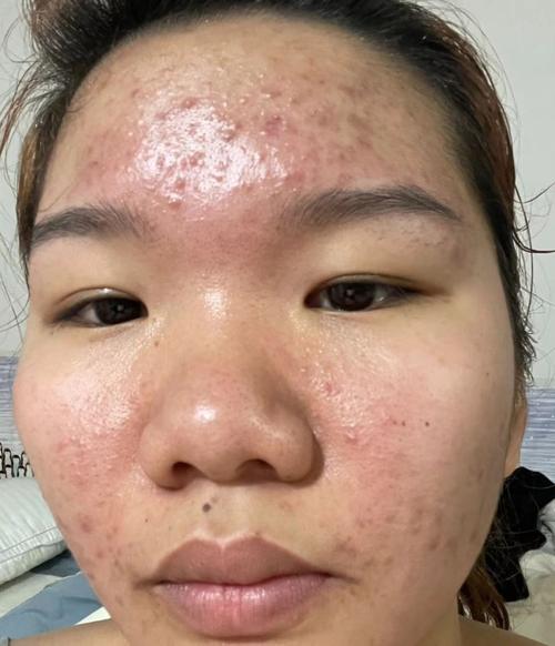 用美白的护肤品长痘痘