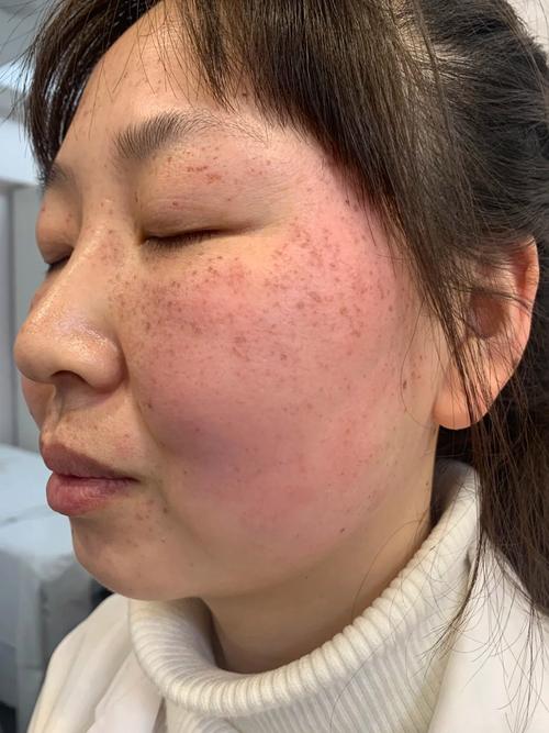 皮秒祛斑是什么