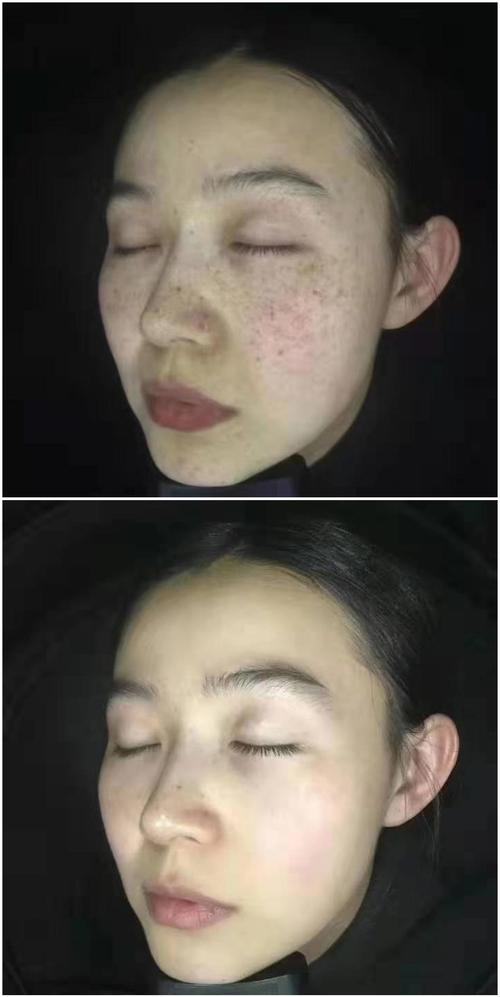 皮秒祛斑是什么