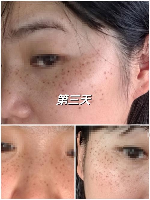 皮秒祛斑是什么