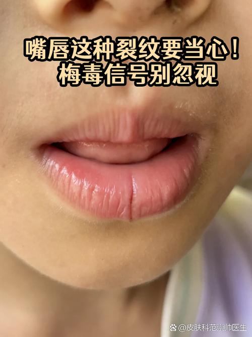嘴唇干裂是什么病
