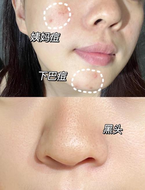 有黑头可以用护肤品吗