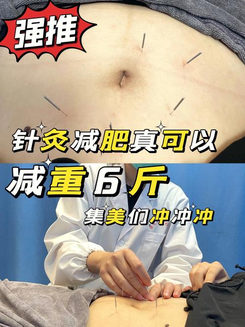 什么季节针灸减肥最好