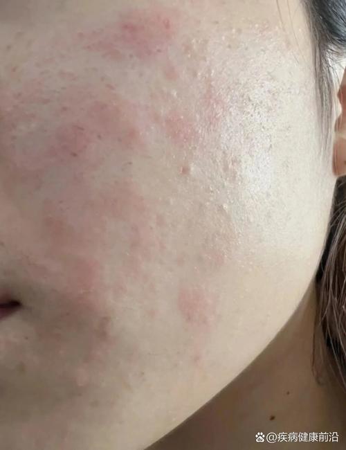 自然堂洗面奶过敏症状