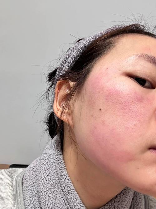 脸部过敏什么症状