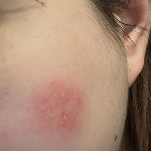 脸部过敏什么症状