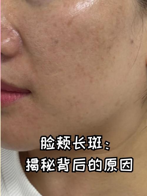 用护肤品脸上会长斑吗