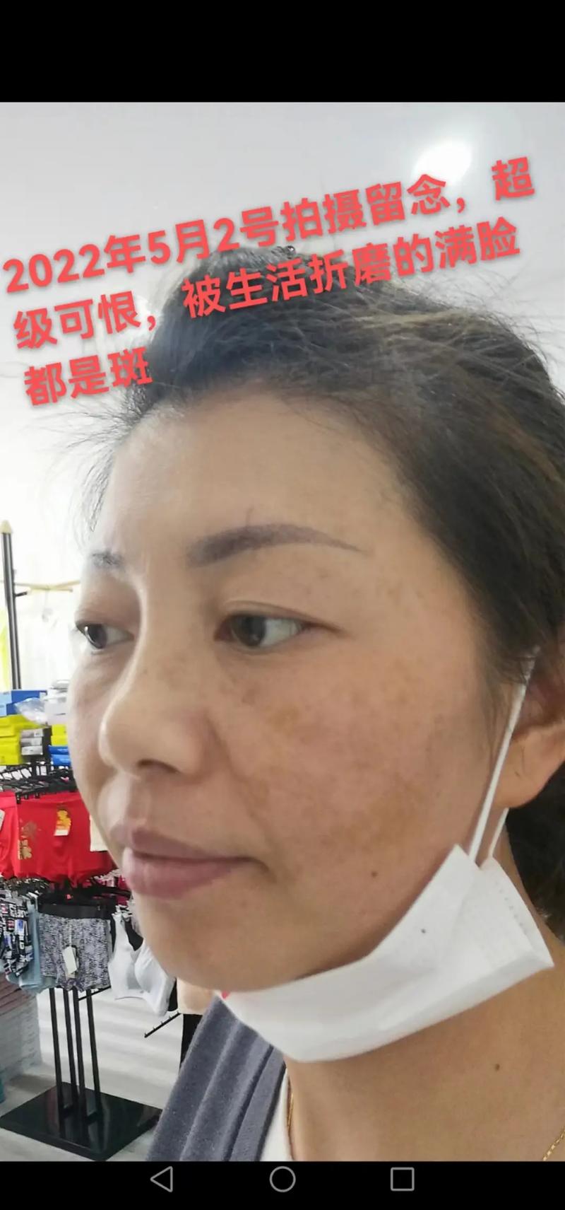 用护肤品脸上会长斑吗