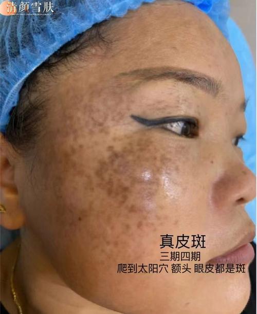 用护肤品脸上会长斑吗