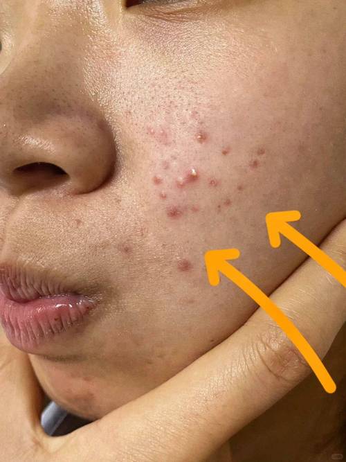 痤疮有什么症状