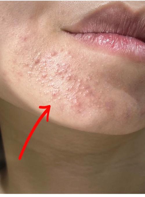 粉刺长什么样子