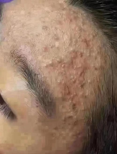 粉刺长什么样子