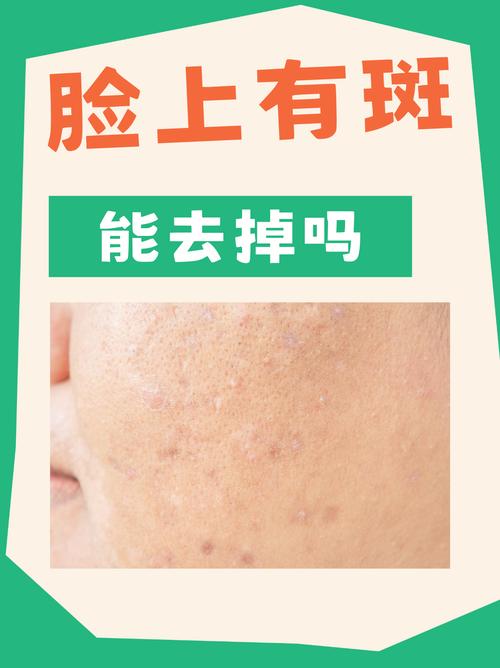 护肤品会让脸上长斑吗