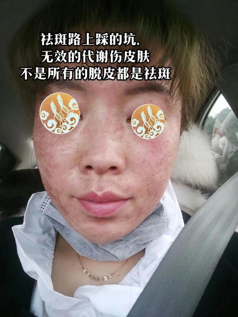 护肤品会让脸上长斑吗