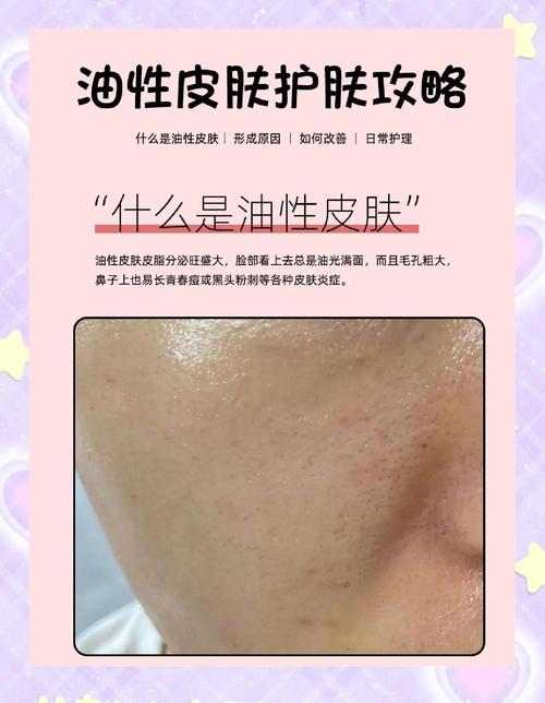 后的护肤品适合油皮吗