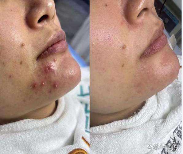 长痘痘不用洗面奶好吗