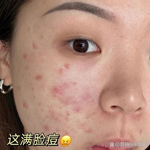 长痘痘不用洗面奶好吗