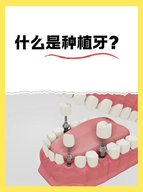 什么是植牙