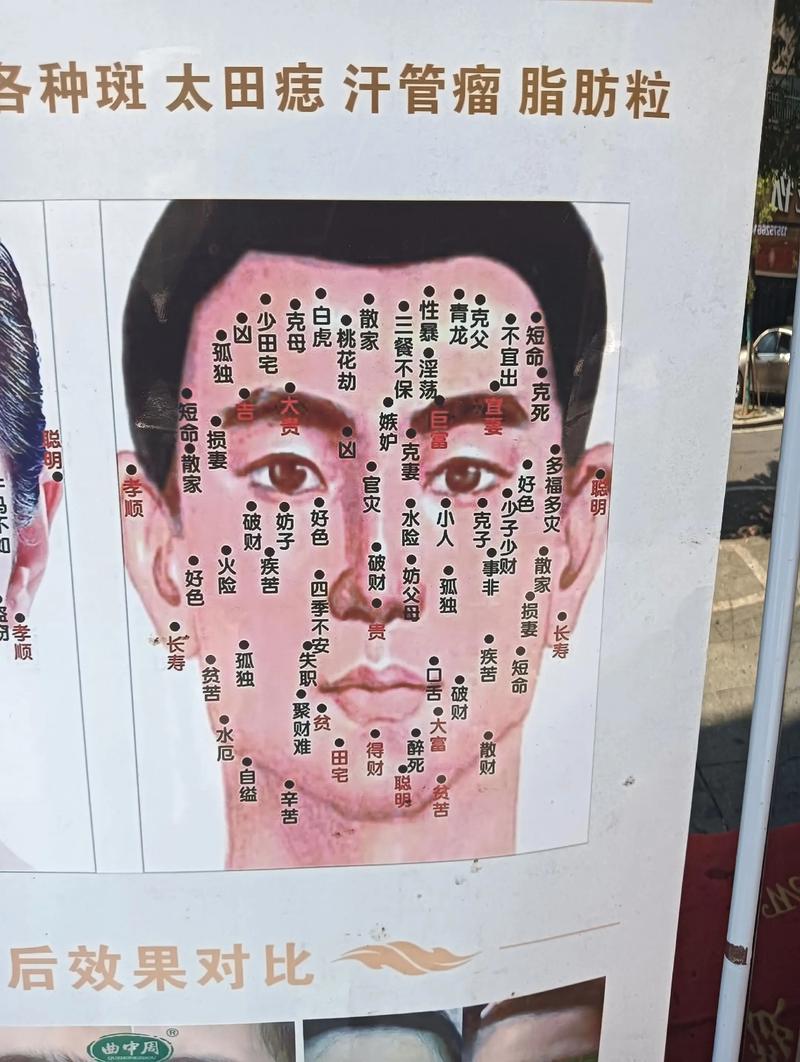 为什么脸上长黑痣