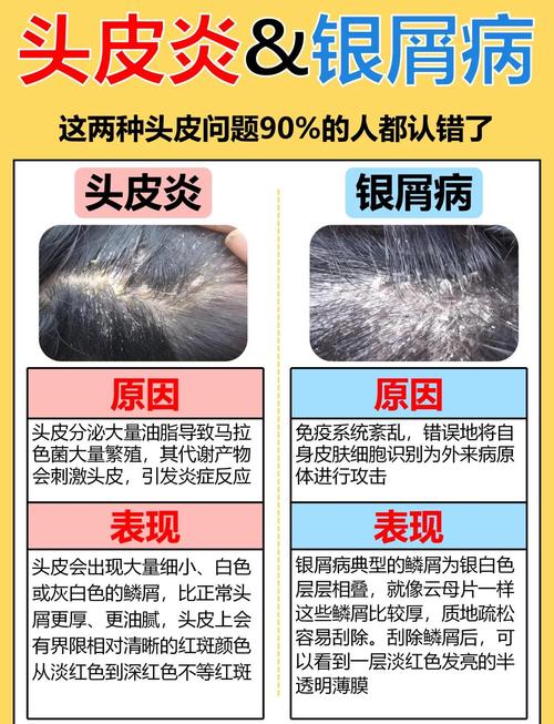 什么能治头皮屑