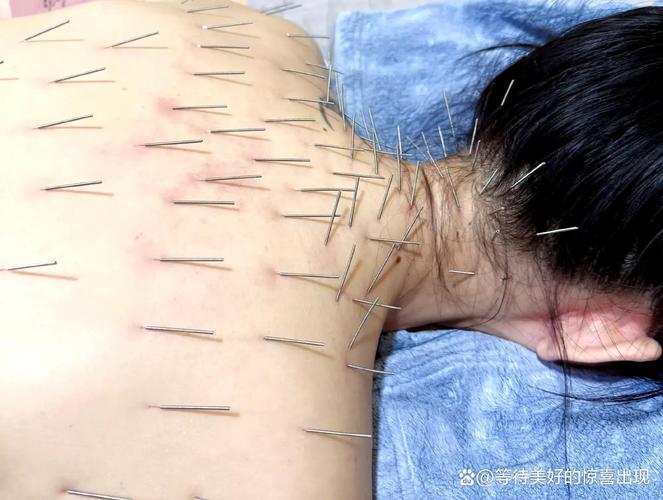 针灸减肥过后有什么反应