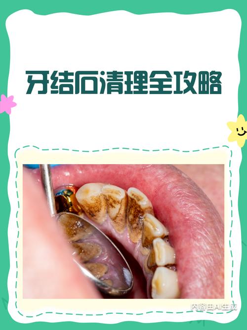 牙结石用什么去除