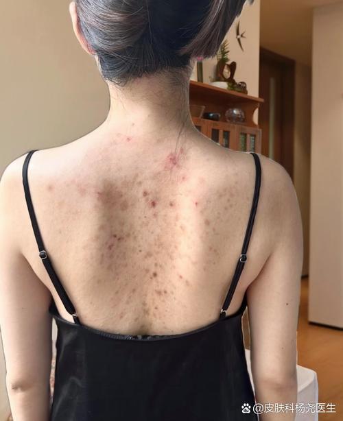 后背为什么会长痘