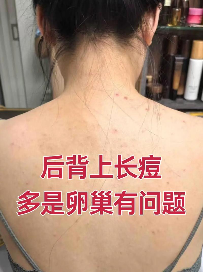 后背为什么会长痘