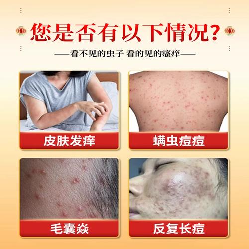 脸上螨虫用什么药