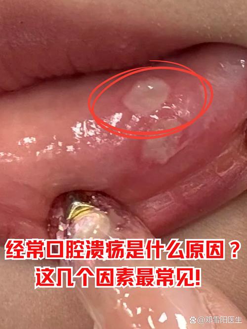 嘴巴溃疡是什么原因