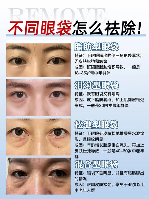 什么是祛眼袋