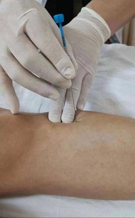 中医埋线减肥埋什么穴位