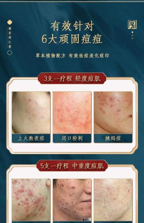 有痘印适合什么护肤品