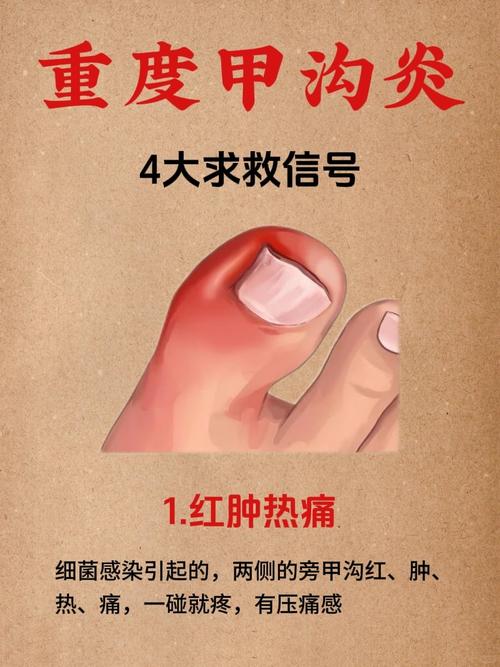 医院甲沟炎挂什么科