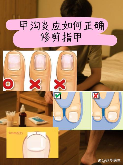 医院甲沟炎挂什么科