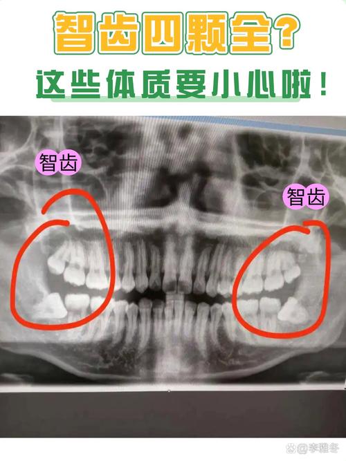 什么是智齿图片