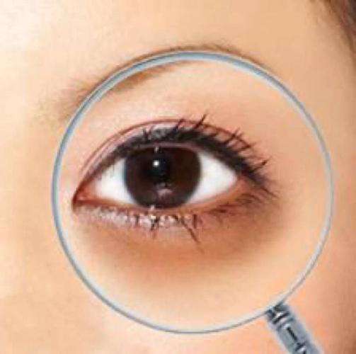 黑眼圈是什么样的