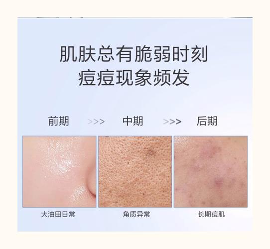 什么去痘印好