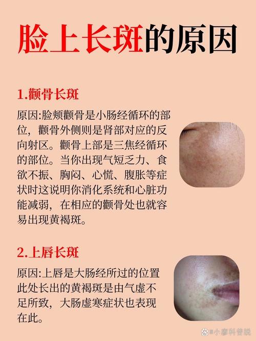 为什么容易长斑