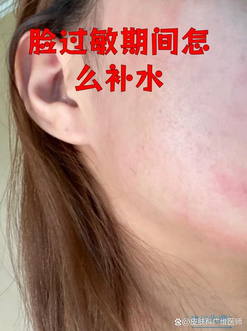 洗面奶洗过敏了怎么办