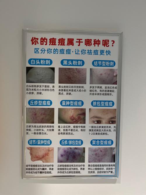 痤疮不能用什么护肤品